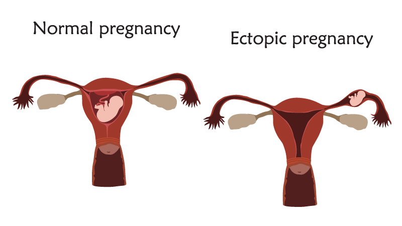 Diagram comparing a normal pregnancy and an ectopic pregnancy in a possible medical malpractice case. The ectopic pregnancy shows a fetus outside the womb.