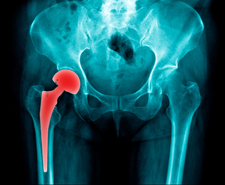 X-ray of a hip replacement device labeled in red symbolizing a defective Exactech hip implant
