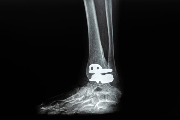 X-ray of an ankle replacement device symbolizing a defective Exactech ankle implant