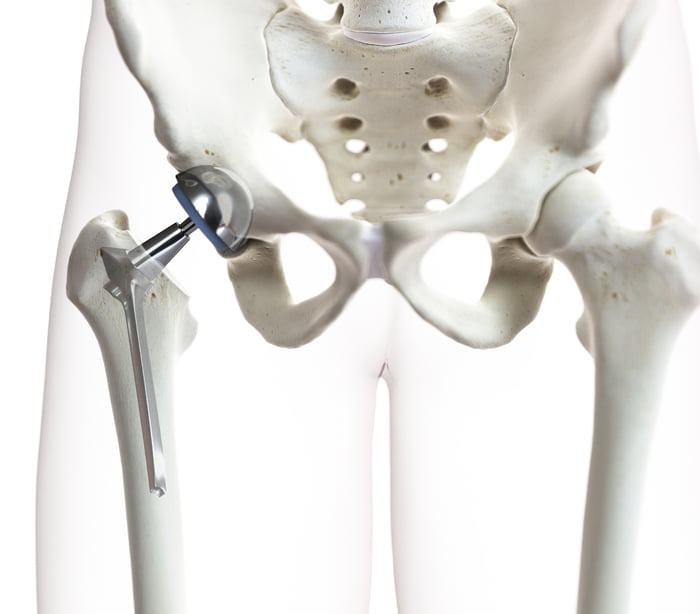 Model of a human skeleton showing how a hip replacement functions