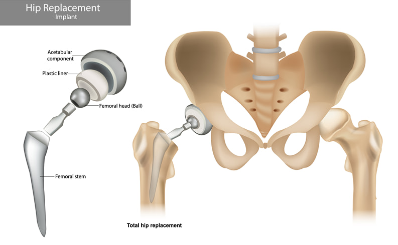 Illustration of a hip replacement implant with labeled components including acetabular component, plastic liner, femoral head (ball), and femoral stem, alongside a skeleton showing total hip replacement