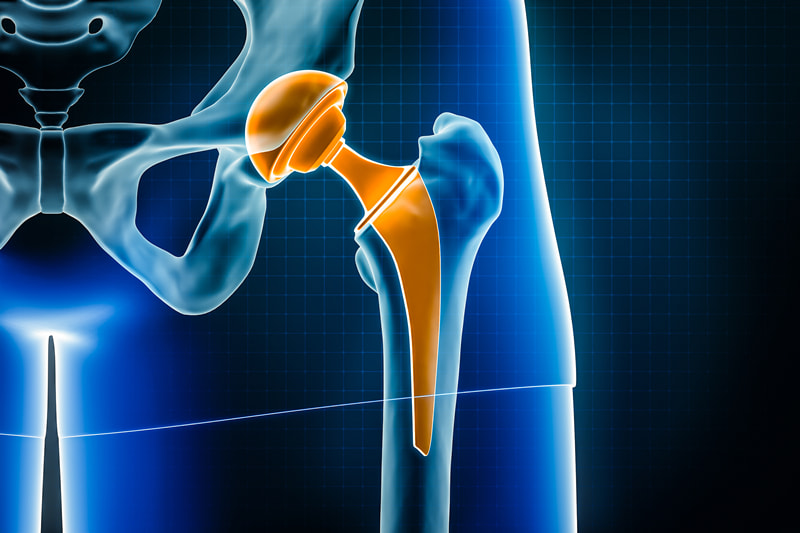 Digital illustration of a hip joint with a metal-on-metal hip replacement, depicting potential metallosis condition.